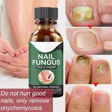 Foot Cure Nail Fungus Solution (Buy 1 Get 1 Free )
