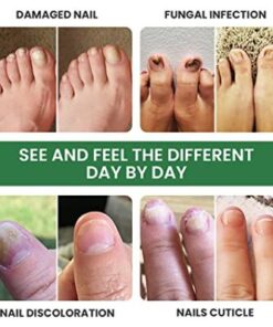Alternative view of Foot Cure Nail Fungus Solution (Buy 1 Get 1 Free )